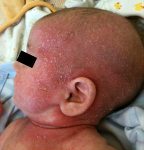 Dermatitis atópica en niños